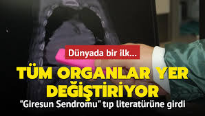 Dünya'da bir ilk! Giresun Sendromu tıp literatürüne girdi